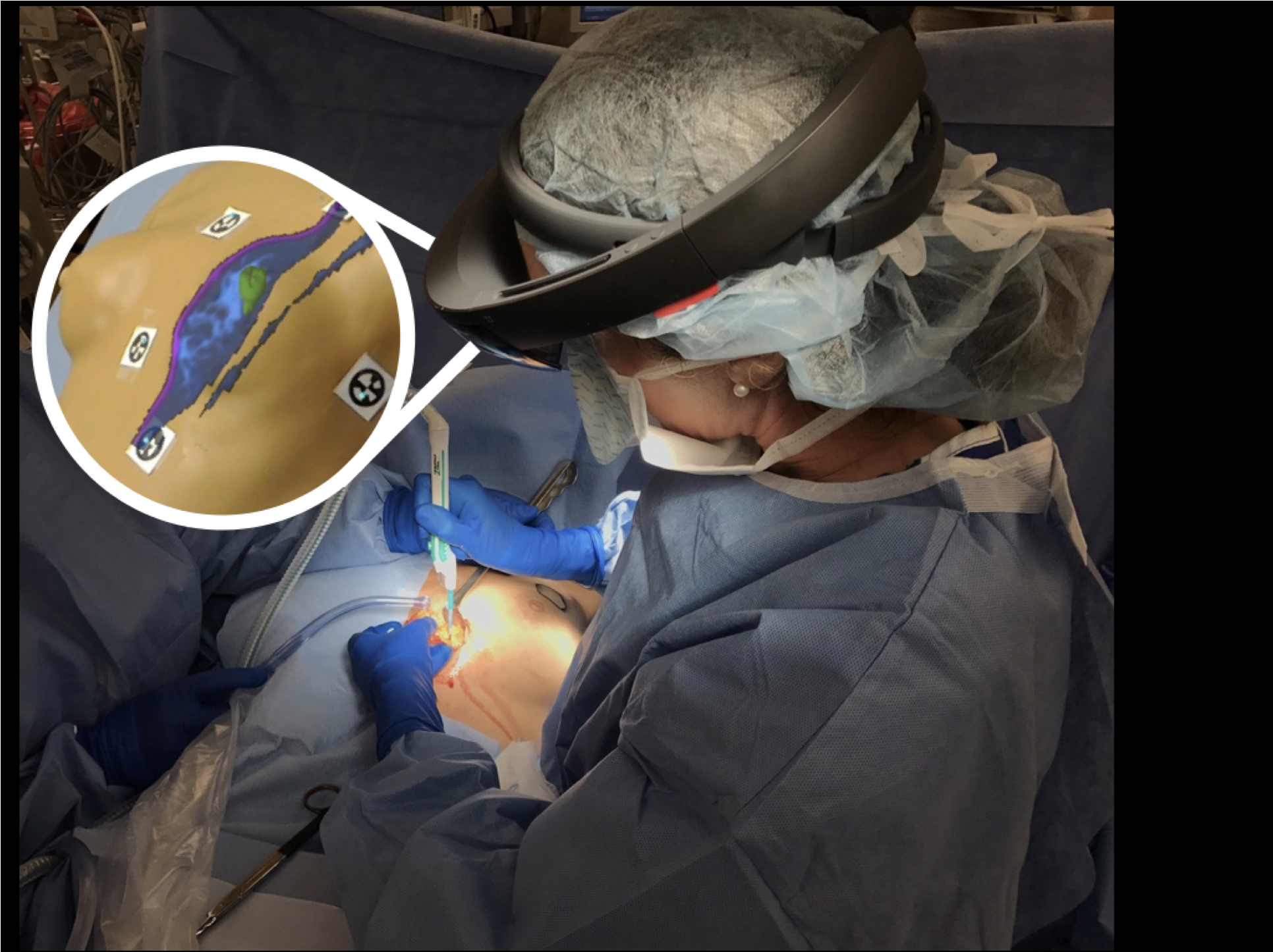 A user wearing a HoloLens looking at holograms of 3D medical imaging of a patient's breast overlayed on the patient